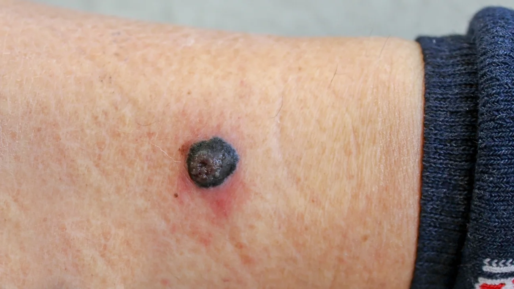 Melanoma and the Other Side